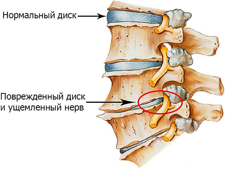 При жиме ногами болит поясница