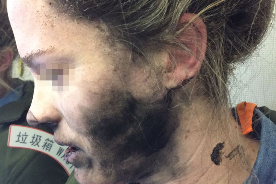 Беспроводные наушники Beats взорвались на голове женщины