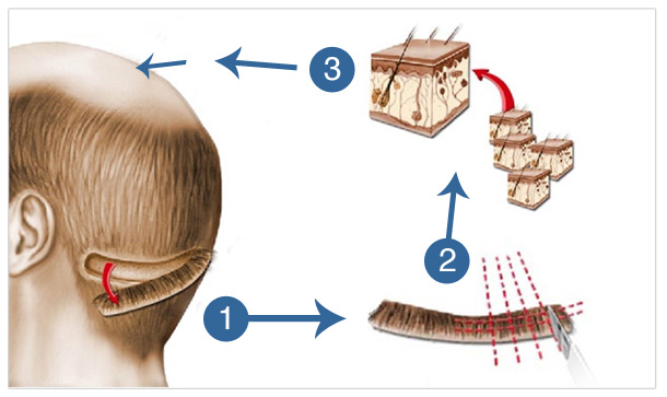 Пересадка волос для мужчин как происходит