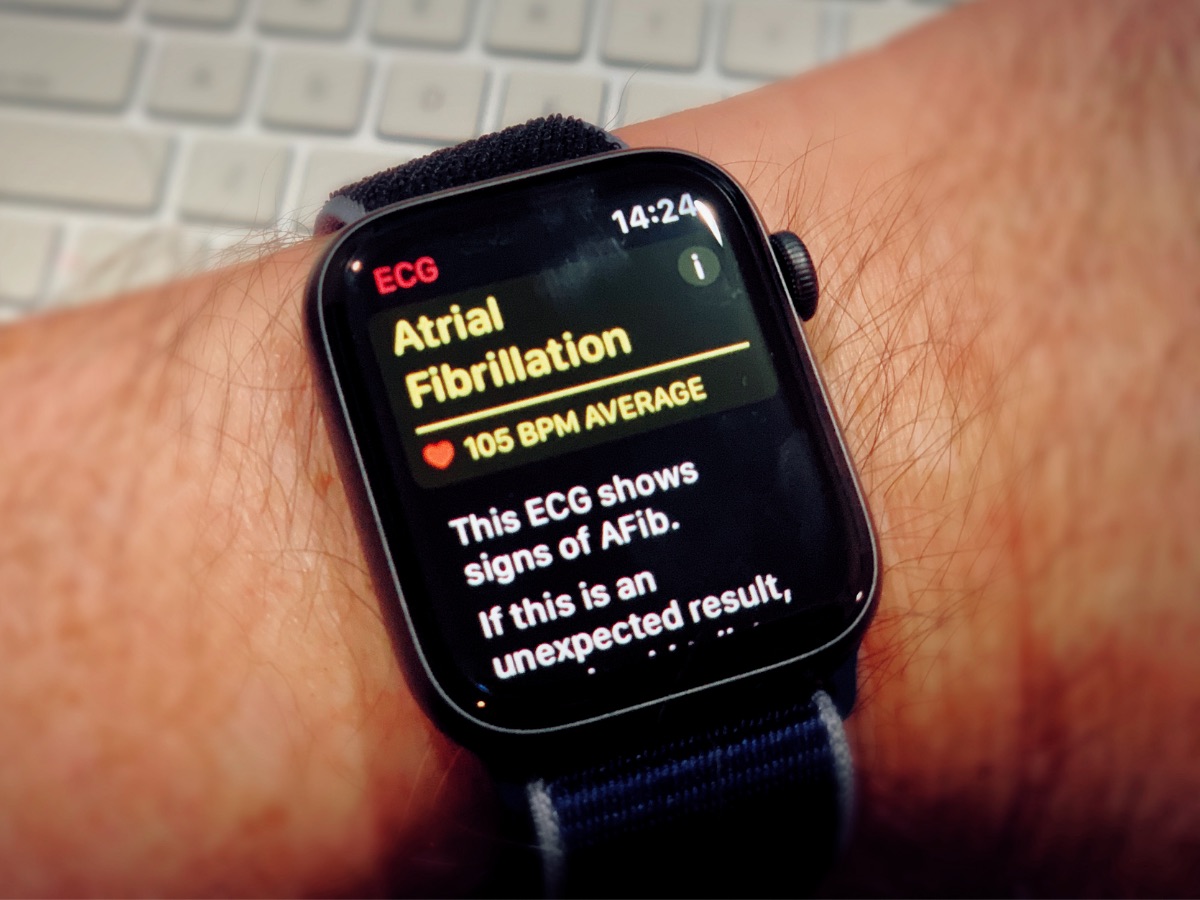 Apple Watch не могут обнаружить проблему с сердцем при пульсе больше 120 ударов в минуту