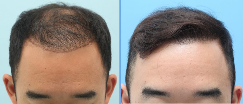 Пересадка волос для мужчин как происходит